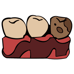 Toothache rotten clipart