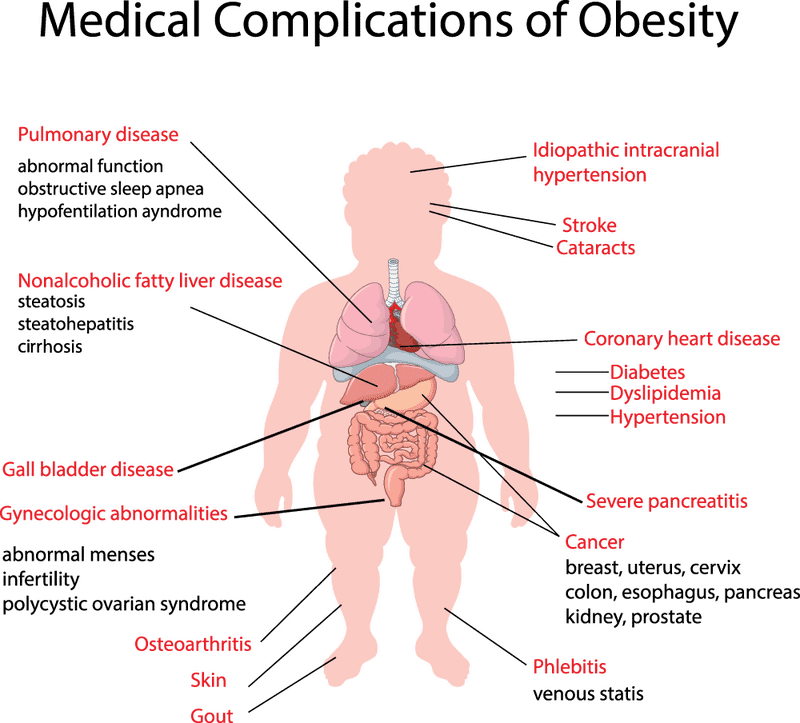 Understanding Medical Syringe Applications in Obesity Treatment PNG