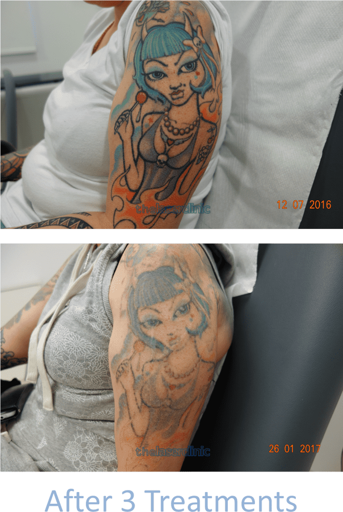 Tattoo Transformation Journey From Bold to Faded PNG