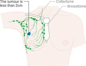 Bone Structure and Tumor Location Overview PNG