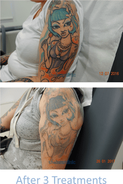 Tattoo Transformation Journey From Bold to Faded PNG