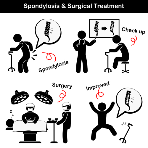 Spondylosis with surgery treatment vector
