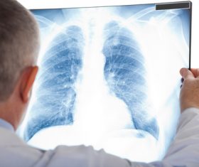 Doctor sees patient lung X-ray film Stock Photo