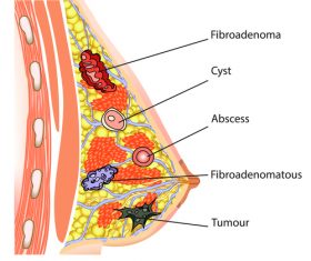 Female breast fibroadenoma vector
