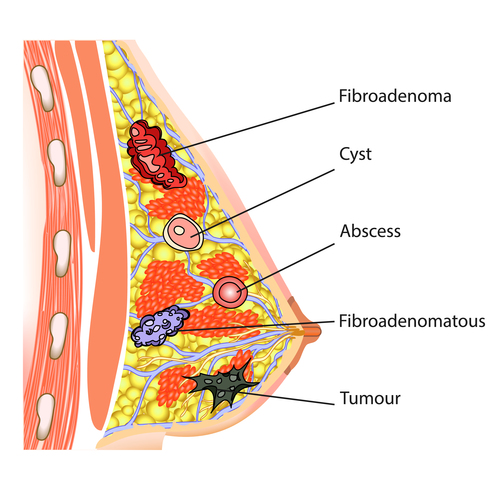 Female breast fibroadenoma vector