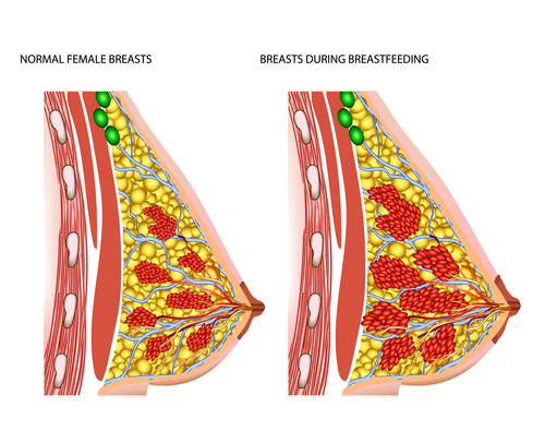 Female breast lesion structure vector