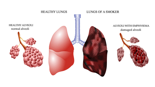 Healthy lungs and lungs of smoker vector
