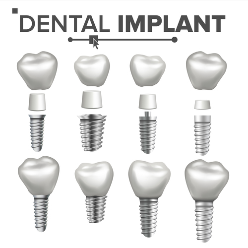 Decomposed dental implant vector