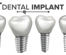 Dental implant model vector