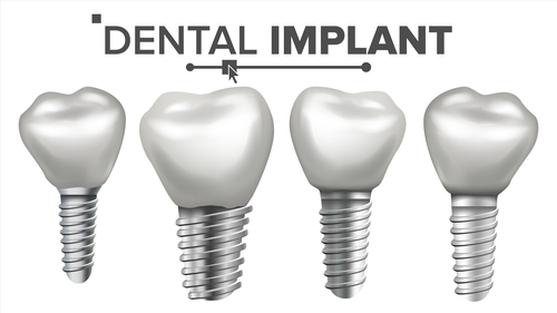 Dental implant model vector
