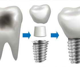 Dental implant vector