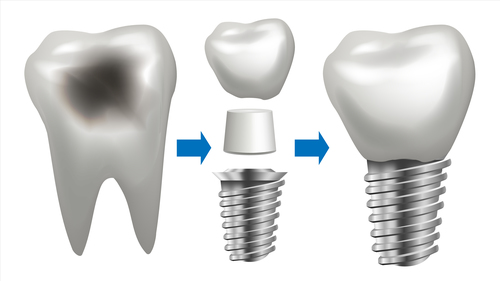 Dental implant vector