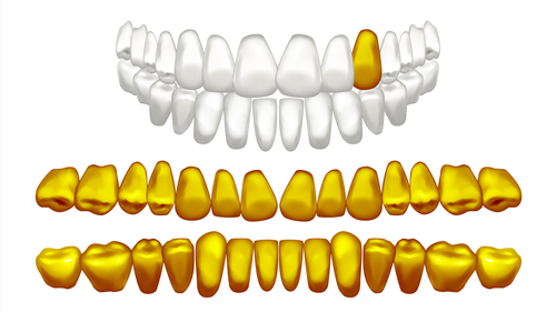 Golden dental implant vector